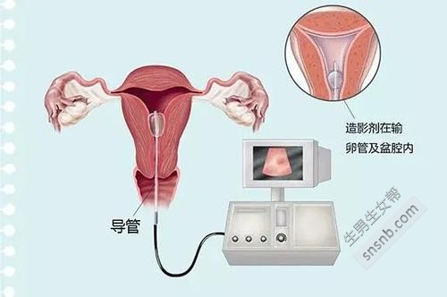 输卵管检查要注意什么 这是做这种检查的最佳时机(图1)